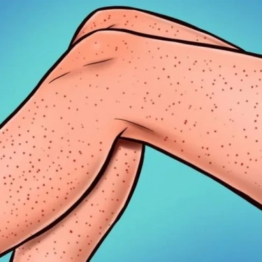 
«Клубничные ножки» - это заболевание кожи, вызванное закупоркой пор, вросшими волосками, фолликулитом или сухостью кожи. Чтобы предотв...