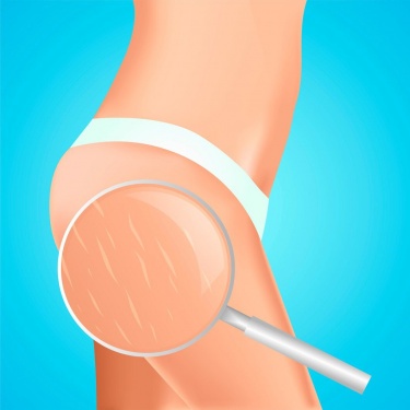 Статья раскрывает основные причины появления растяжек и предлагает эффективные способы их профилактики. Читатели узна...